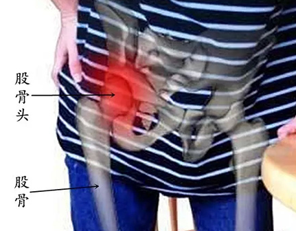 股骨頭壞死的原因_股骨頭壞死要盡早預防