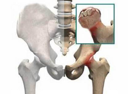 髖關節(jié)脫位的危害_髖關節(jié)脫位的危害大嗎？